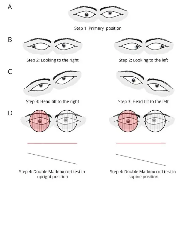 A test for clinical reasoning with a man with vertical diplopia in image D.