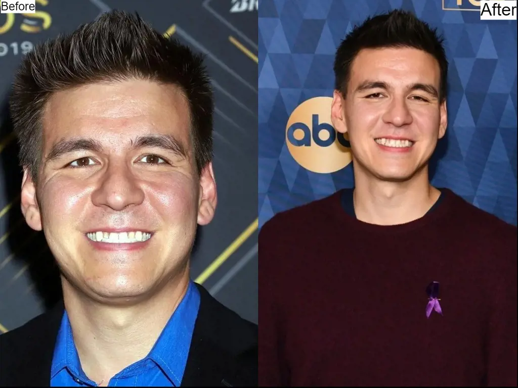 Holzhauer has a slight change in his physical appearance losing his facial bones 